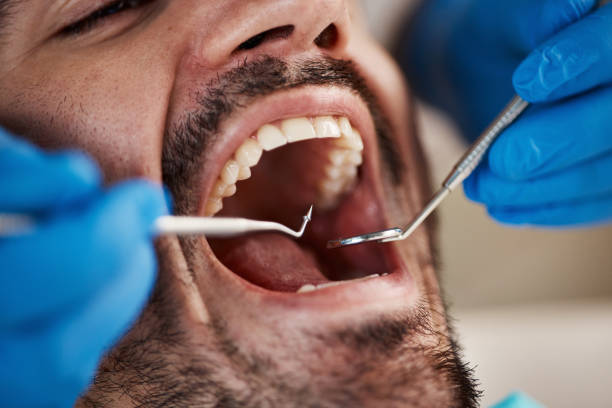 Best Emergency Tooth Extraction in Little Canada, MN